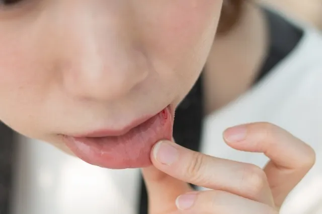 知ってるようで知らない「口内炎」を知ろう!