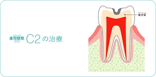 進行状態C2