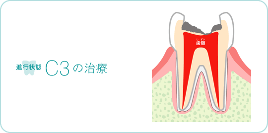 進行状態C3